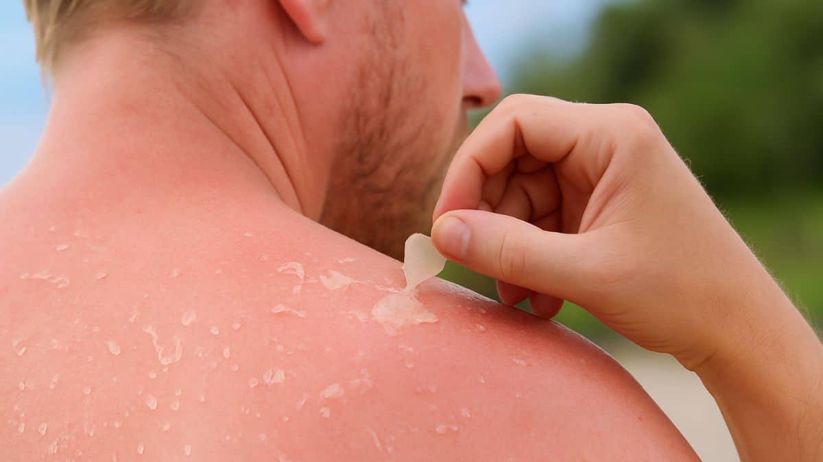 Peau du dos qui pèle après un coup de soleil, avec une main en train de retirer une pellicule de peau abîmée.